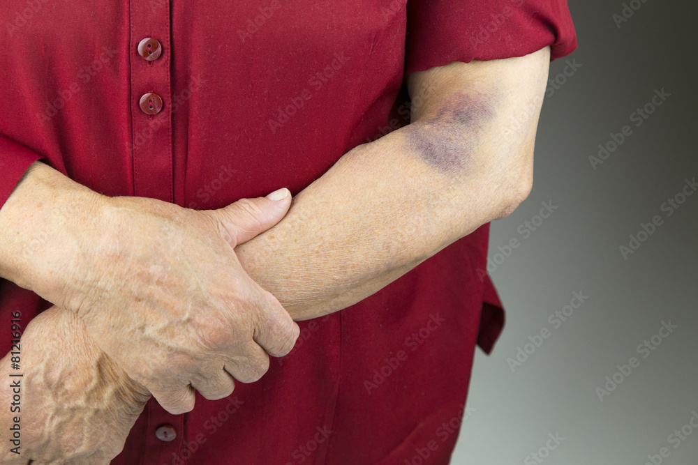 Large hematoma on human arm Stock Photo Adobe Stock