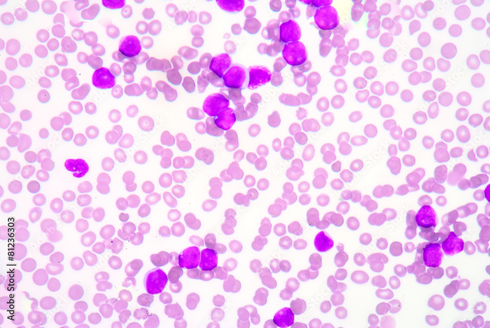 A blood smear is often used as a follow-up test to abnormal resu