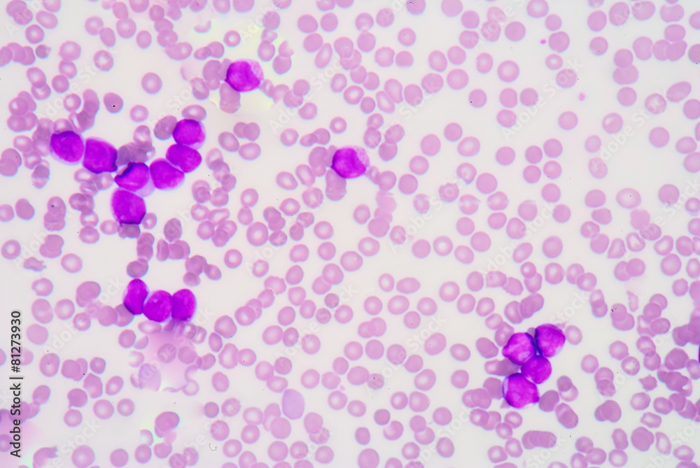 A very highly magnified view of human blood during a leukemoid r A very highly magnified view of human blood during a leukemoid r