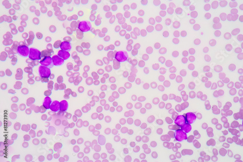 A very highly magnified view of human blood during a leukemoid r