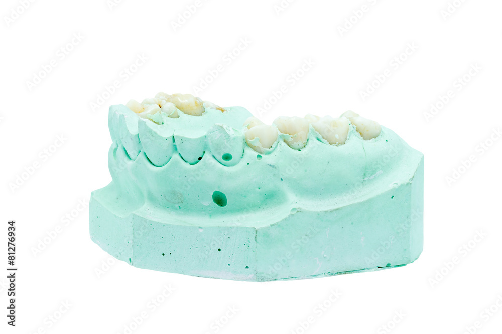 Denture cast model Denture cast model