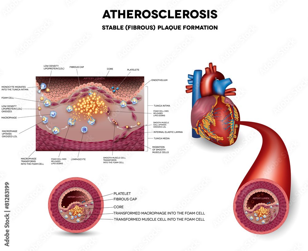 Fatty streak formation in the artery. It may lead to thrombosis, Stock ...