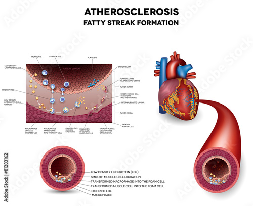 Atherosclerosis. Early stage of atherosclerosis when Fatty strea