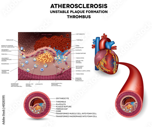 Fatty streak formation in the artery. It may lead to thrombosis,