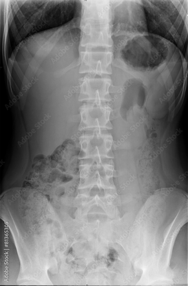 Xray Spine and Pelvis of a Human Body Xray Spine and Pelvis of a Human Body