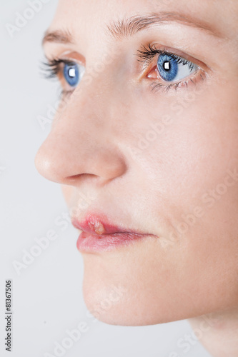 beautiful woman with lips virus infected herpes photo
