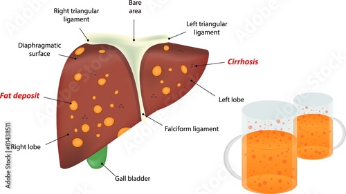 Alcohol Related Liver Disease