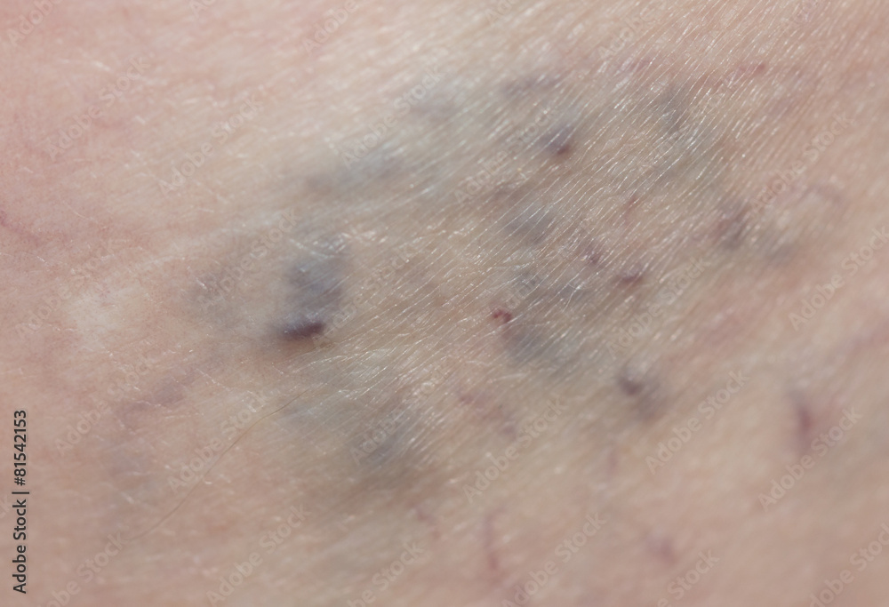 Fototapeta premium varicose veins in the leg
