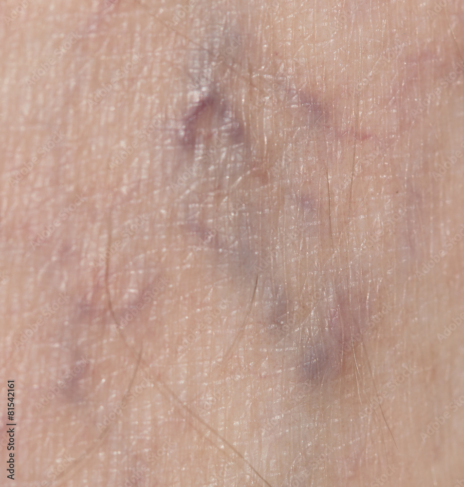 Fototapeta premium varicose veins in the leg