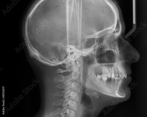 Lateral cephalometric radiograph photo