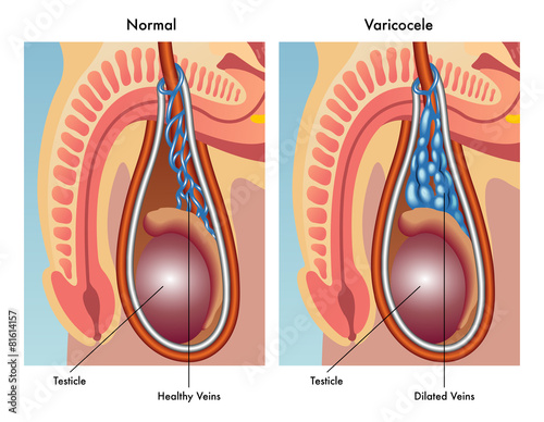 varicocele