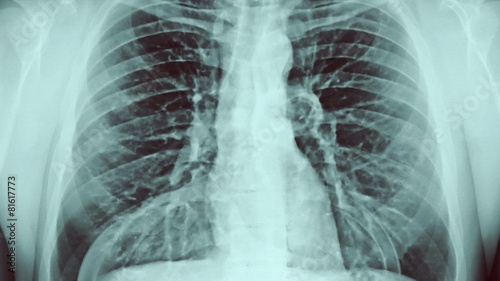 Chest x-ray and gases.