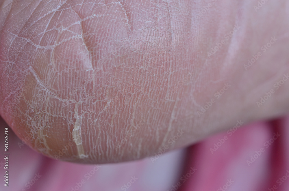Fototapeta premium dry heel cracks