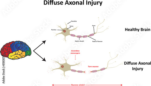 Diffuse Axonal Injury after Car Crash