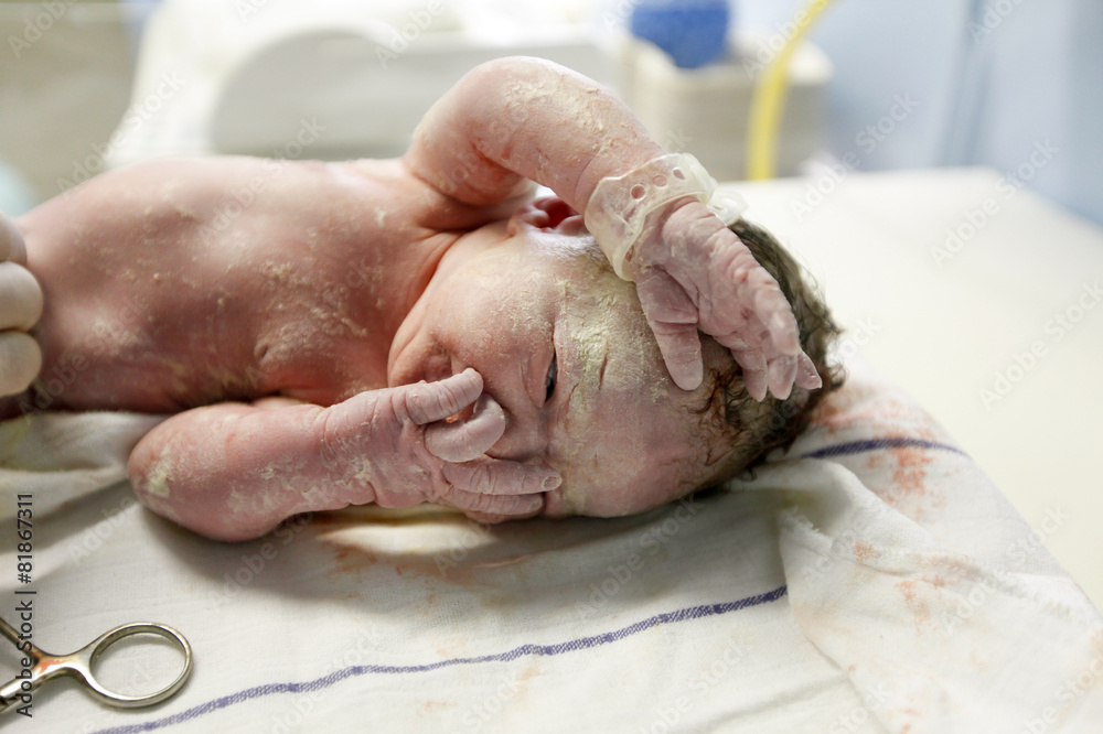Vernix covered newborn after delivery