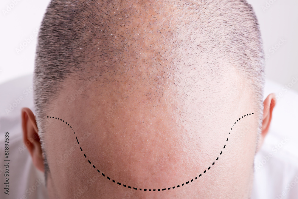 Hair Loss Hair Loss