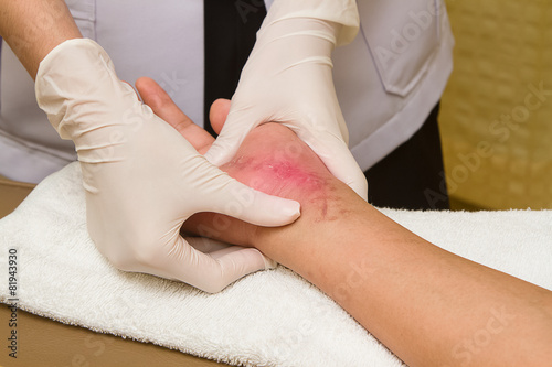 Patient getting a therapy massage on scar