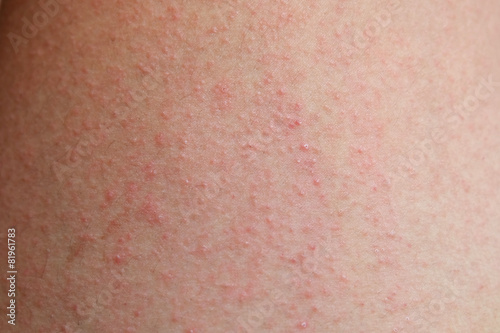  allergic rash dermatitis skin of patient photo