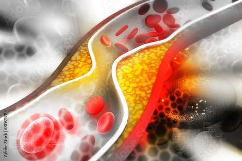 Cholesterol plaque in artery