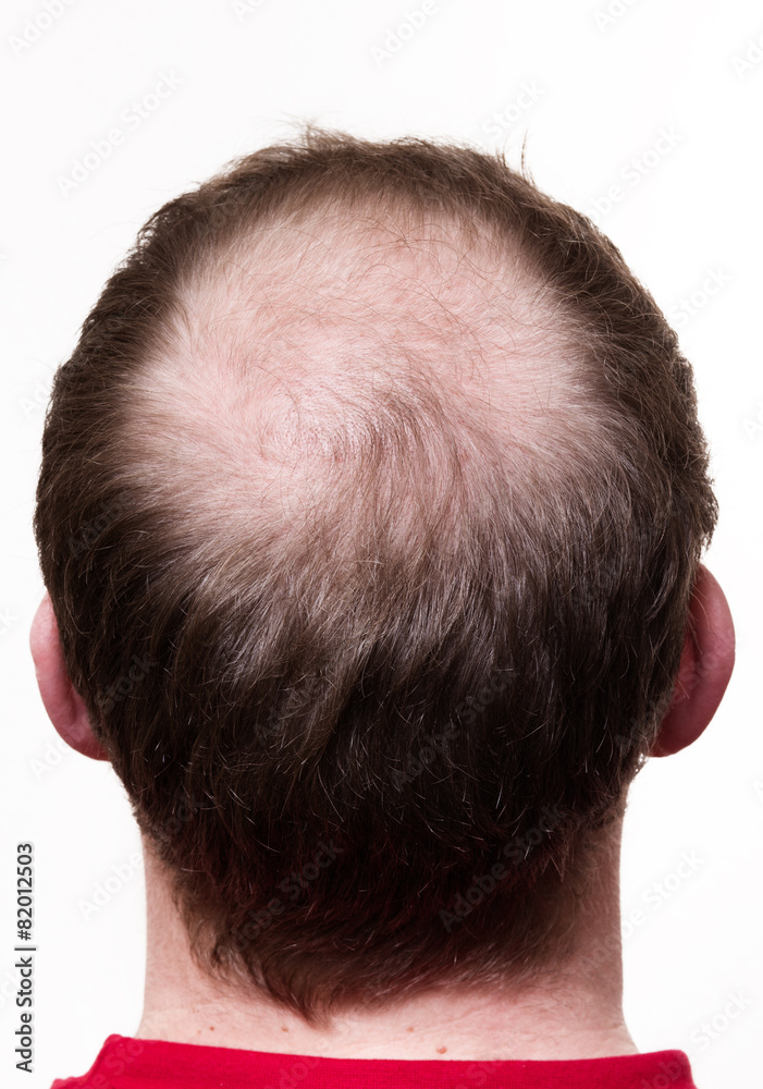 Obraz premium Kopf mit wenig Haaren