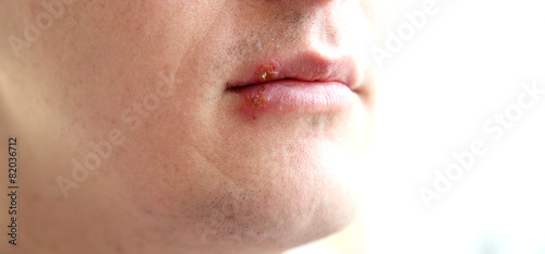 herpes on the lips photo