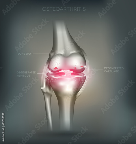 Osteoarthritis knee joint destruction