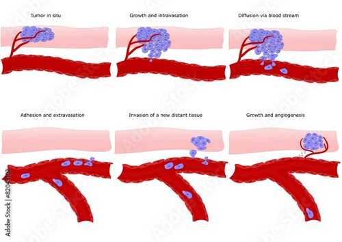 metastasi: formazione a distanza di un cancro photo