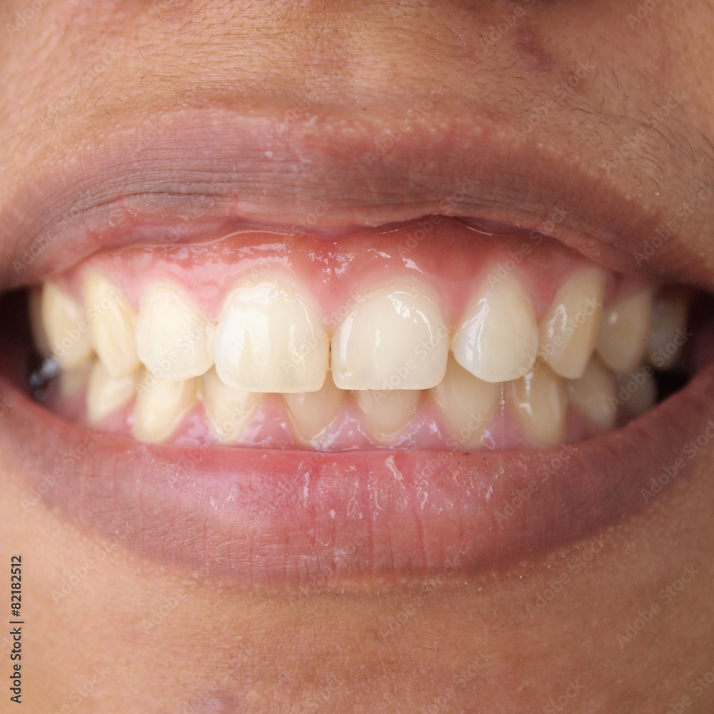 Fototapeta premium Diastema between the upper incisors is a normal feature