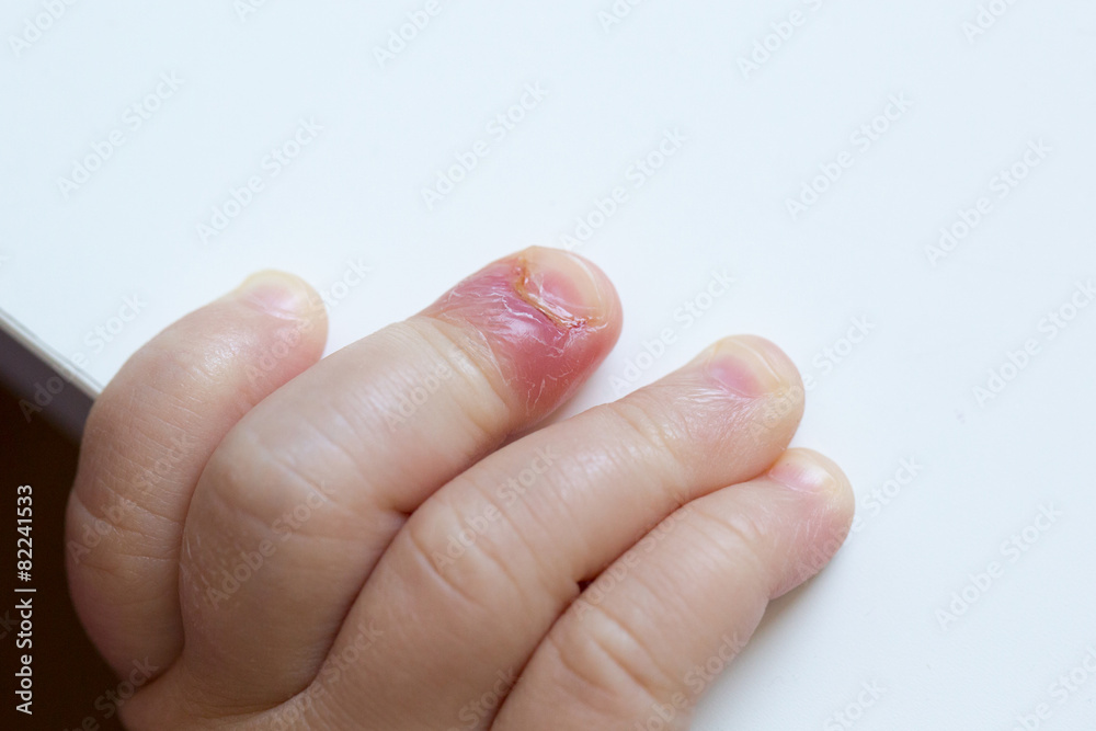 Fingernail bed inflammation, bacterial infection