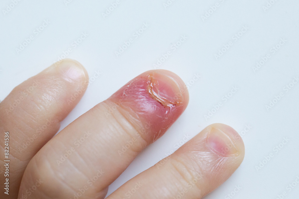 Fingernail bed inflammation, bacterial infection