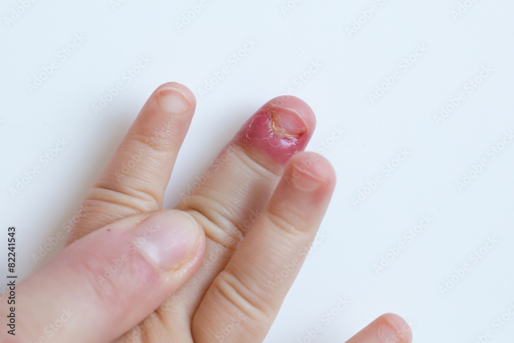 Fingernail bed inflammation, bacterial infection
