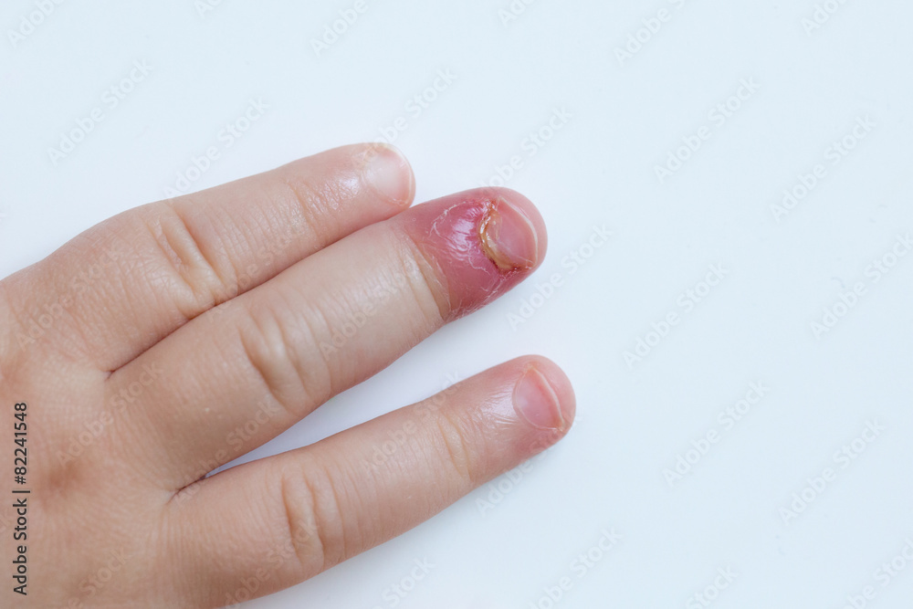 Fingernail bed inflammation, bacterial infection Fingernail bed inflammation, bacterial infection