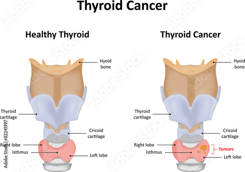 Thyroid Cancer photo