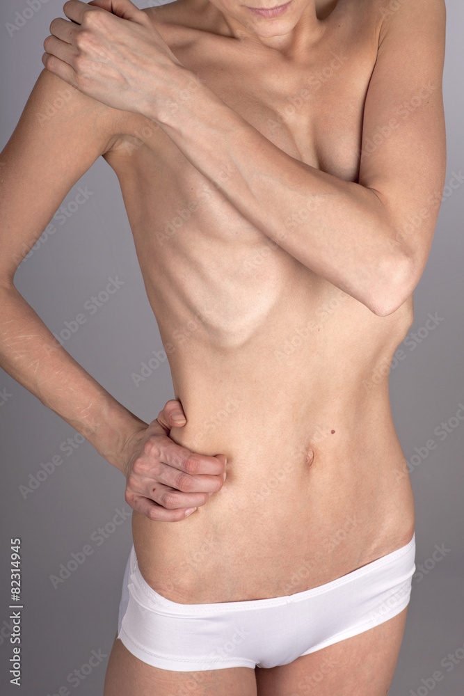 Magersüchtige Frau, halbnackt, Oberkörper, Bauch Magersüchtige Frau, halbnackt, Oberkörper, Bauch