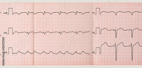Tape ECG with paroxysm of atrial flutter photo