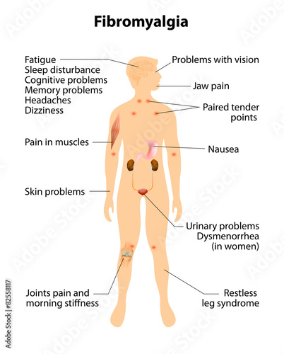 fibromyalgia. signs and symptoms. photo