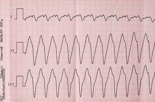 Tape ECG with paroxysm correct form of atrial flutter