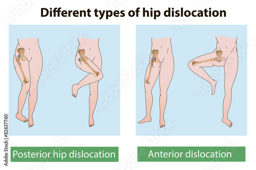hip dislocation