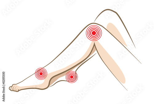 Concept of woman pain in legs, vector