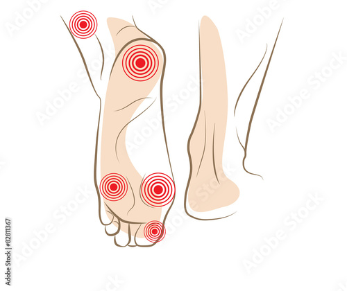 Concept of woman foot pain, vector