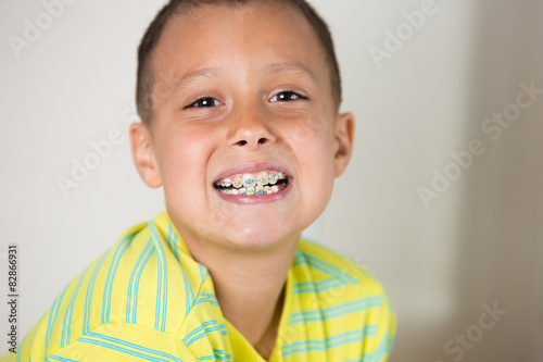 Boy showing his braces on his teeth.