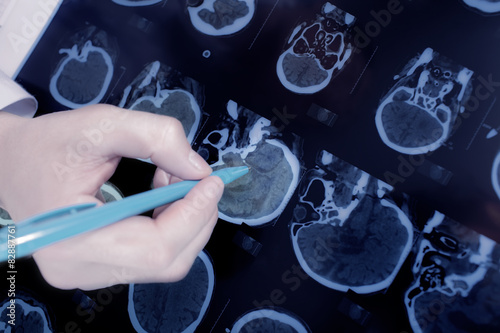 close-up of the doctor hand pointing to the brain CT photo