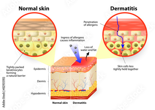 dermatitis or eczema photo