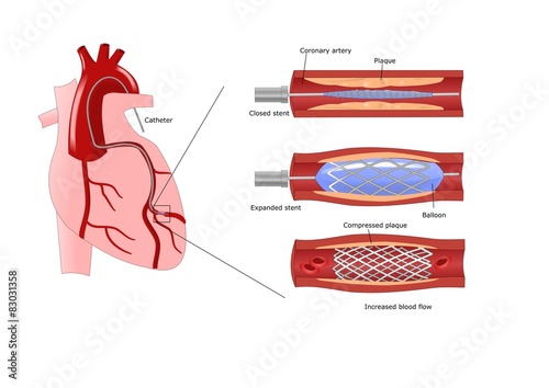 introduzione via catetere di uno stent coronarico