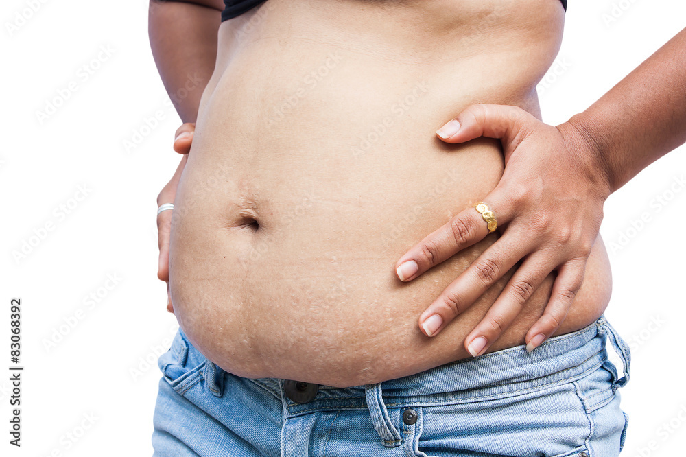Women body with fat belly and stretch marks. Women body with fat belly and stretch marks.
