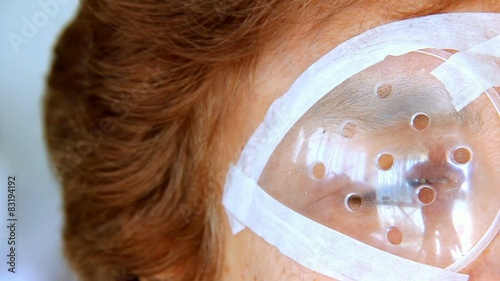 Mature female eye after surgery