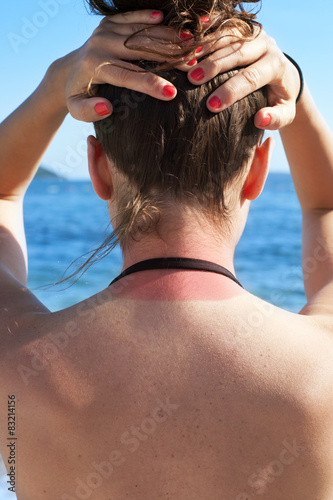Young woman showing neck sunburn on the beach in summer