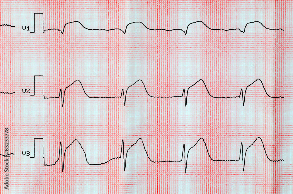 ECG with acute period macrofocal anterior myocardial infarction ECG with acute period macrofocal anterior myocardial infarction