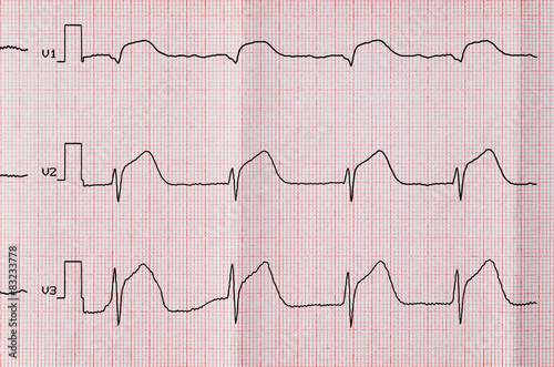 ECG with acute period macrofocal anterior myocardial infarction