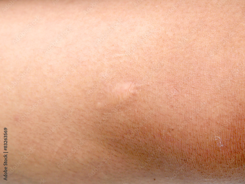 Fototapeta premium scar on the skin. macro
